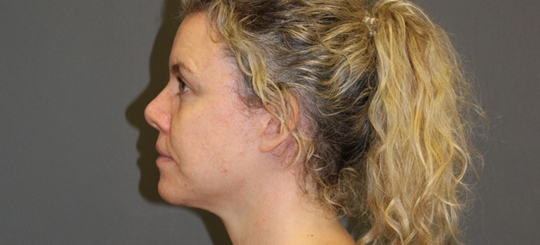 Før-efter billede af facelift. Kvindes ansigt i profil efter ansigtsløft.