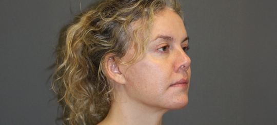 Før-efter billede af facelift. Kvindes ansigt skråt forfra efter ansigtsløft.