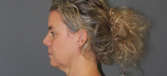 Før-efter billede af facelift. Kvindes ansigt i profil før ansigtsløft.