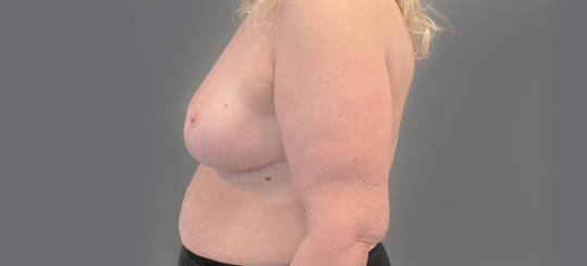 Før-efter billede af brystreduktion. Kvindes bryster i profil efter brystreduktion.