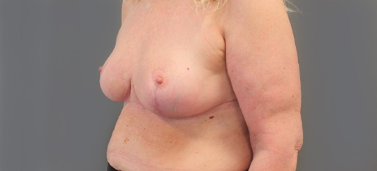 Før-efter billede af brystreduktion. Kvindes bryster skråt forfra efter brystreduktion.