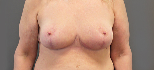 Før-efter billede af brystreduktion. Kvindes bryster forfra efter brystreduktion.