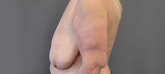 Før-efter billede af brystreduktion. Kvindes bryster i profil før brystreduktion.