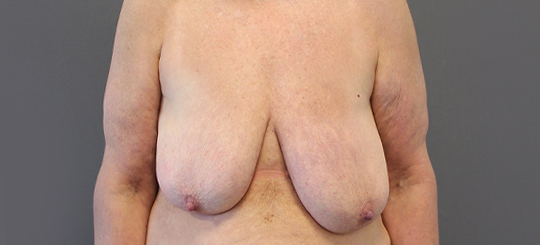 Før-efter billede af brystreduktion. Kvindes bryster forfra før brystreduktion.