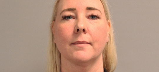 Før-efter billede af halskorrektion. Kvindes hals set forfra efter fedtsugning af hals og hage.