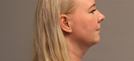 Før-efter billede af halskorrektion. Kvindes hals set i profil efter fedtsugning af hals og hage.