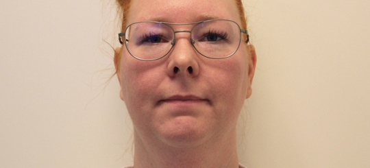 Før-efter billede af halskorrektion. Kvindes hals set forfra før fedtsugning af hals og hage.