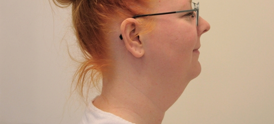 Før-efter billede af halskorrektion. Kvindes hals set i profil før fedtsugning af hals og hage.