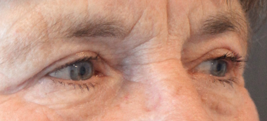 Før-efter billede af øjenlågsoperation. Kvindes øjne fra siden efter øjenlågsoperation.