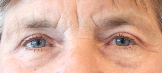 Før-efter billede af øjenlågsoperation. Kvindes øjne set forfra efter øjenlågsoperation.