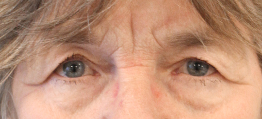 Før-efter billede af øjenlågsoperation. Kvindes øjne set forfra før øjenlågsoperation.