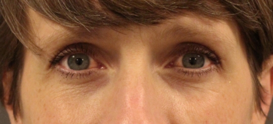 Før-efter billede af øjenlågsoperation. Kvindes øjne set forfra efter øjenlågsoperation.