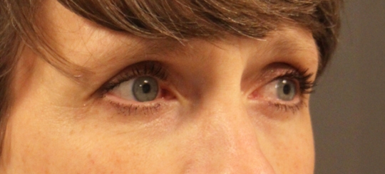 Før-efter billede af øjenlågsoperation. Kvindes øjne fra siden efter øjenlågsoperation.