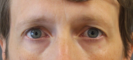 Før-efter billede af øjenlågsoperation. Kvindes øjne set forfra før øjenlågsoperation.