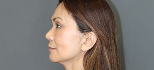Før-efter billede af facelift. Kvindes ansigt i profil efter ansigtsløft.