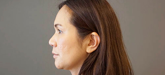 Før-efter billede af facelift. Kvindes ansigt i profil føransigtsløft.