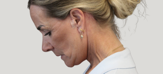 Før-efter billede af facelift. Kvindes ansigt