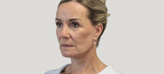 Før-efter billede af facelift. Kvindes ansigt