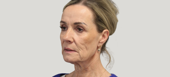 Før-efter billede af facelift. Kvindes ansigt