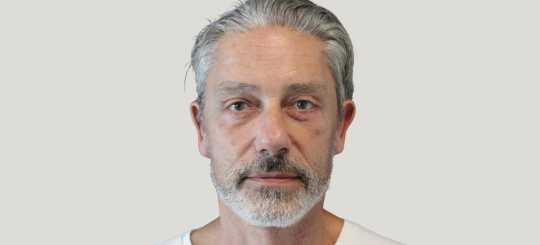 Før-efter billede af facelift. Mands ansigt.
