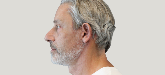 Før-efter billede af facelift. Mands ansigt.