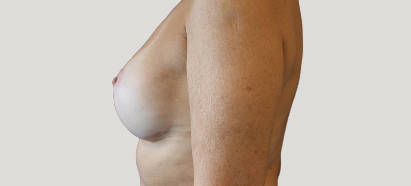 Før-efter billede af udskiftning af bryst implantater og brystløft. Kvindes bryster i profil efter operation.