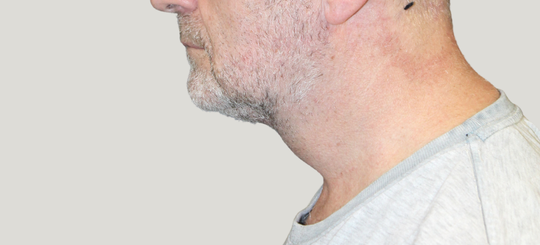 Før-efter billede af halsløft og fedsugning. Mand i profil efter før halsløft og fedsugning.